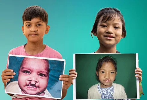 The Smile Train Collaboration